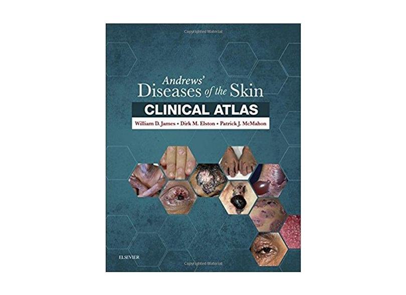 ANDREWS DISEASES OF THE SKIN CLINICAL ATLAS - William D. James & Dirk Elston & Patrick J. Mcmahon - 9780323441964