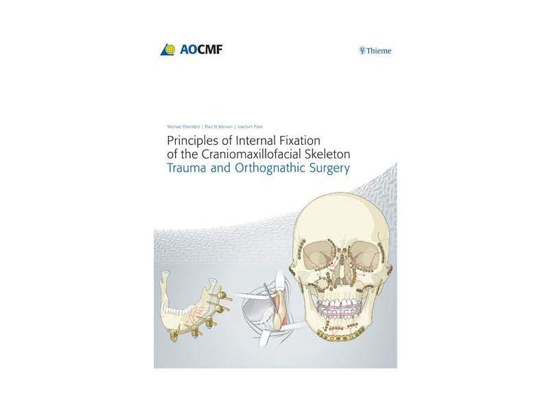 Principles of Internal Fixation of the Craniomaxillofacial Skeleton: Trauma and Othognathic Surgery - Joachim Prein - 9783131714817