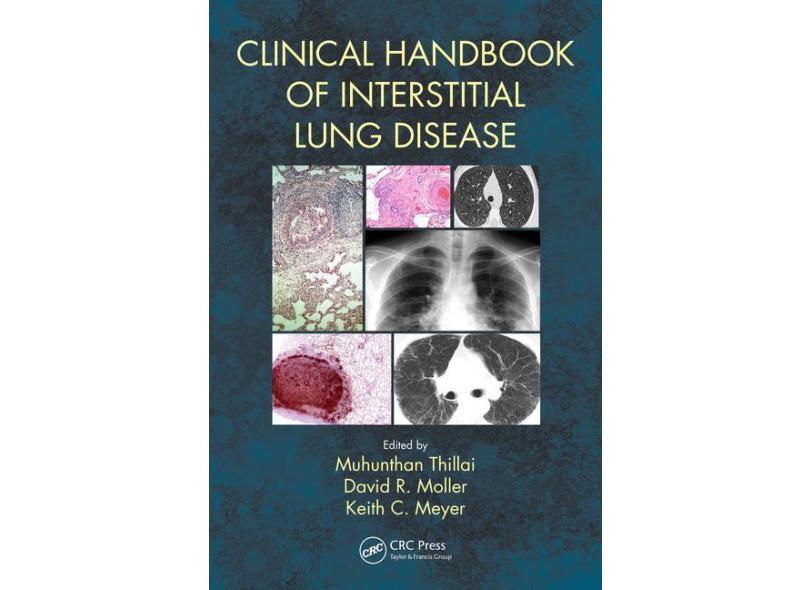 Clinical Handbook Of Interstitial Lung Disease - "thillai, Muhunthan" - 9781498768252