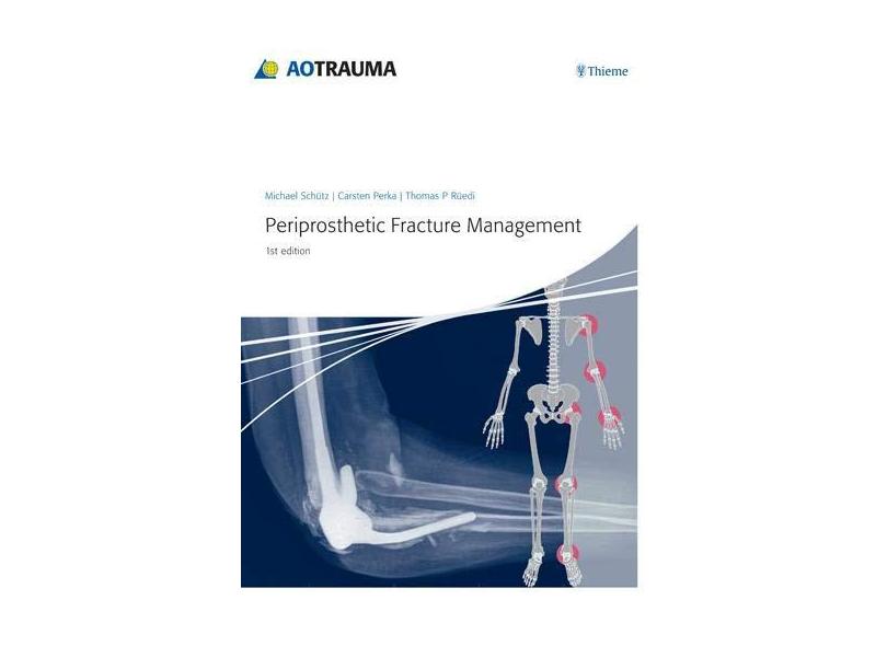 Periprosthetic Fracture Management - Michael Schutz - 9783131715111