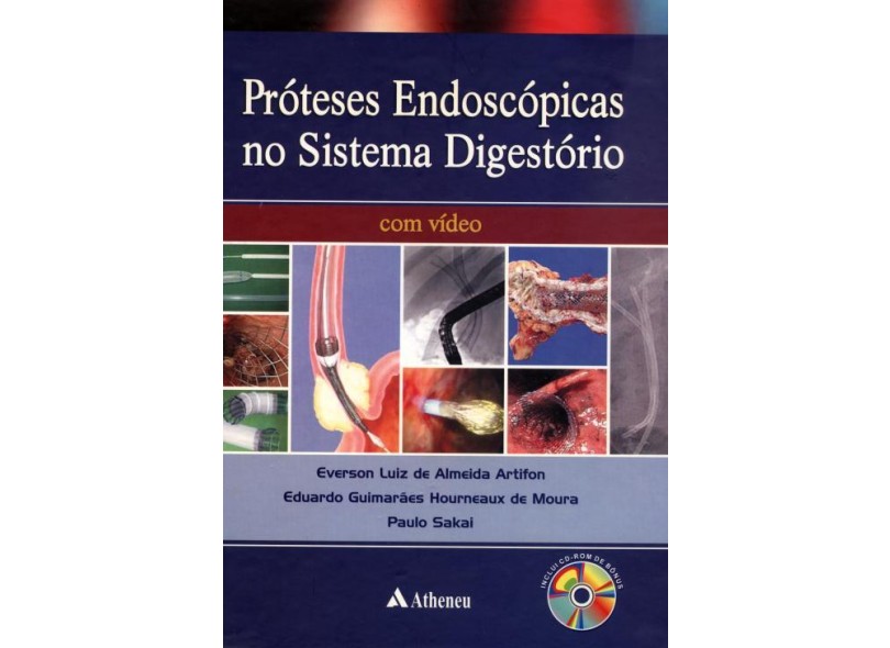 Próteses Endoscópicas No Sistema Digestório Sakai, Paulo; Artifon, Everson Luiz De Almeida