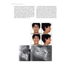 Livro - Ortodontia Interceptiva: Protocolo de Tratamento em Duas Fases