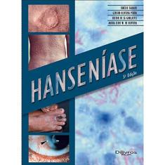 Hanseníase