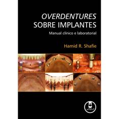 Livro - Overdentures sobre Implantes: Manual Clínico e Laboratorial