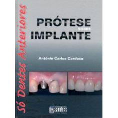Livro - Prótese Sobre Implante - Só Dentes Anteriores