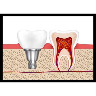 Imagem de Quadro Decorativo Dentista Consultórios Odontológicos Dentes Implantes