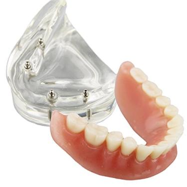 Imagem de Smile1000 Modelo Odontológico Overdenture Inferior 4 Implantes Demo para Ensino e Estudo