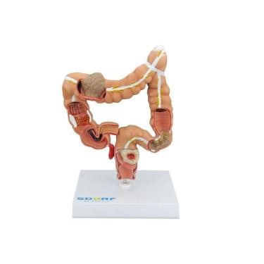 Imagem de Modelo Patológico do Cólon e Reto SD-5203