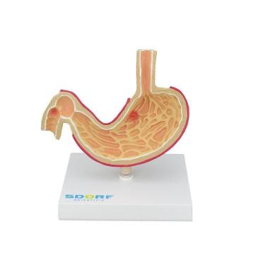 Imagem de Modelo Patológico Do Estômago