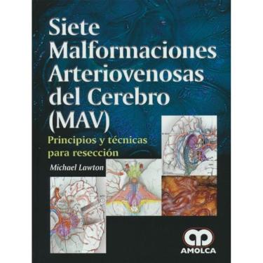 Imagem de Siete Malformaciones Arteriovenosas Del Cerebro (mav)