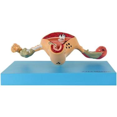 Imagem de Útero Com Trompas Patológico Em Prancha, Anatomia