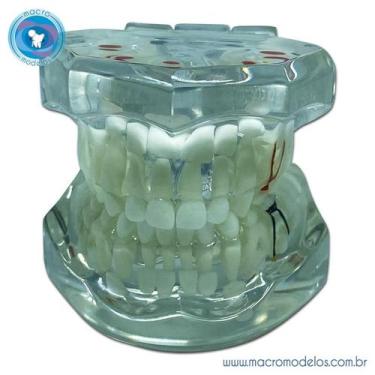 Imagem de Macro Modelo Dentição Decídua em Acrílico Transparente - Macro Modelos