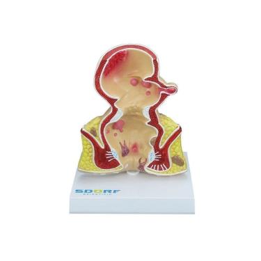 Imagem de Modelo Patológico do Reto SD-5204