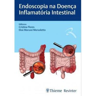 Imagem de Endoscopia Na Doenca Inflamatoria Intestinal
