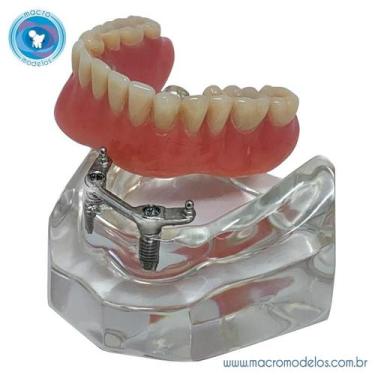 Imagem de Macro Modelo Mandíbula Overdenture Acrílica com 2 Barra Bola e Prótese