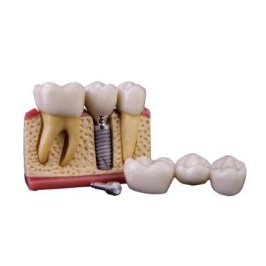 Imagem de Macro modelo manequim odontológico com implante e prótese - ROIC