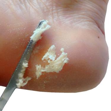 Imagem de 1 peça de ferramentas de faca de pedicure para pés de aço inoxidável arquivos de remoção de pele morta ferramenta de manicure para raspagem de pés, 15,5 x 0,6 cm