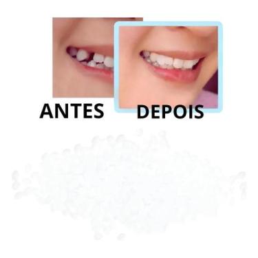 Imagem de Massinha Restauração Dente Provisório+ De 300 Bolinhas Massa - Congrat
