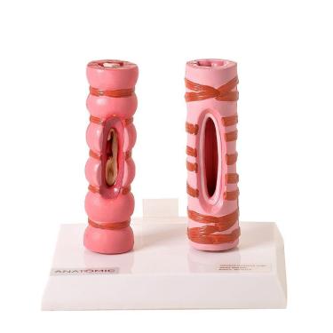 Imagem de Brônquio Saudável e Patológico Comparação