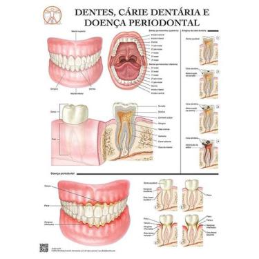 Imagem de Pôster Dentes, Cárie Dentária E Doença Periodontal - Body Scientific