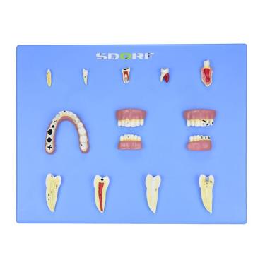 Imagem de Modelo de Patologias Dentárias em 12 Partes em Placa