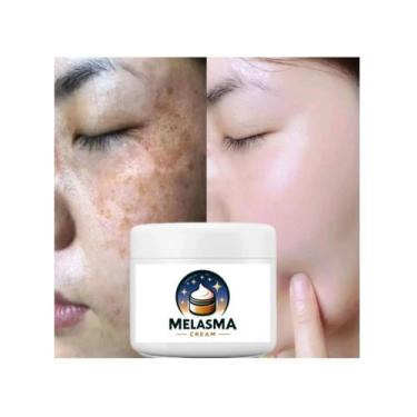 Imagem de Creme para Melasmas e Manchas na Pele 30g. - Melasma Cream