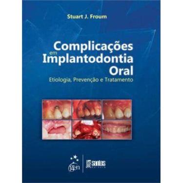 Imagem de Livro - Complicações em Implantodontia Oral - Etiologia, Prevenção e T