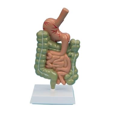 Imagem de Modelo de lesão de cólon humano modelo de lesão de intestino grande gastrointestinal patológico doença intestinal