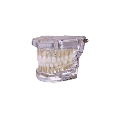 Imagem de Modelo odontológico de ortodontia Classe I oclusão normal transparente