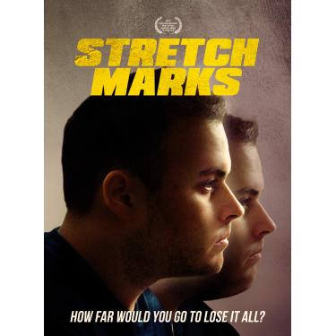 Imagem de Stretch Marks