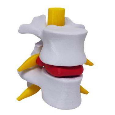 Imagem de Modelo Anatômico Hérnia Disco Lombar Coluna Vertebral Ortopedia 3D - P