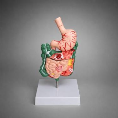 Imagem de Modelo Anatômico do Sistema Digestivo com Patologias, com estômago sec