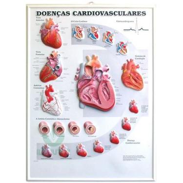 Imagem de Pôster 3D de Doenças Cardiovasculares em Alto-Relevo - LAUTZ