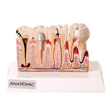 Imagem de Patologia Dentária e Placa Explicativa em 2 Partes Modelo Anatômico
