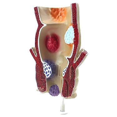 Imagem de AMDHZ 1,5X Modelo de lesão de fissura do reto humano - Anatomia Humana - Modelo de Patologia Anorretal Fístula Hemorroida Modelo de Ensino de Patologia Médica Modelo de Órgão