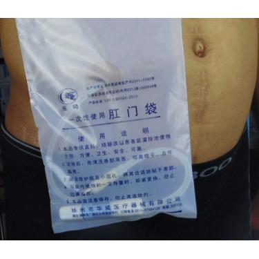 Imagem de 100 Pcs Cateter De Proteção De Água Descartável - Saco De Armazenamento De Cateter De Chuveiro Para Ostomia, Diálise Abdominal & Procedimento Laparoscópico