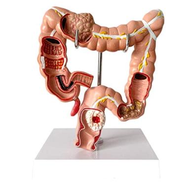 Imagem de RRGJ Modelo de ensino, modelo anatômico de intestino grande humano, modelo de lesão visceral, modelo de patologia do cólon em PVC, anatomia humana, sistema digestivo, estudando, ensinando anatomia biologia