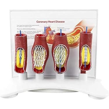 Imagem de 1 modelo de stent vascular humano - demonstração anatômica de bloqueio vascular e oclusão para treinamento de uso em saúde
