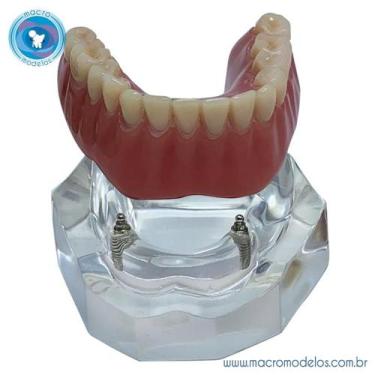 Imagem de Macro Modelo Mandíbula Overdenture Acrílica com 2 ORings e Prótese Inf