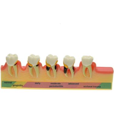 Imagem de Modelo de ensino de estudo de tipodonte de dentes de dente de doença periodontal dentária, modelo de desenvolvimento de cárie dentária modelo de dentes tipodonte de dente.