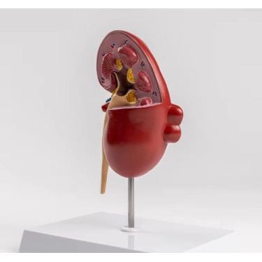 Imagem de Modelo Anatômico Rim Com Patologia Pedra Rins Urológico - KIDNEY DISSE