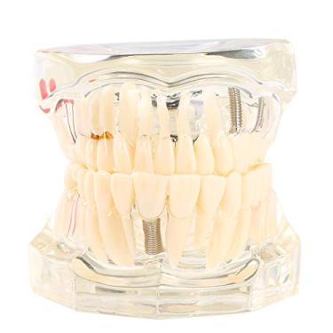 Imagem de Implantação Dental Transparente Doença Modelo de dentes Modelo de dentes Ferramenta Dental Adulto Modelo de dentes removíveis de adulto Modelo