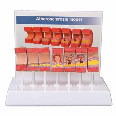 Imagem de Modelo de aterosclerose, modelo de tromboembolismo vascular, vaso sanguíneo arterial, modelo de ensino médico médico humano, modelo de anatomia da artéria de 7 partes para médicos, ferramenta
