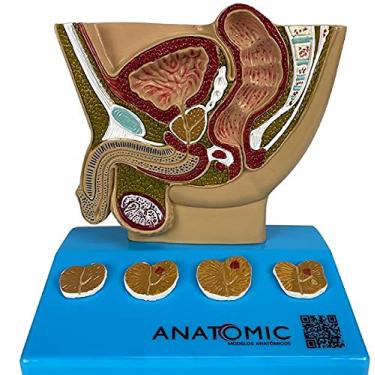 Imagem de Modelo de Próstata, com Patologias