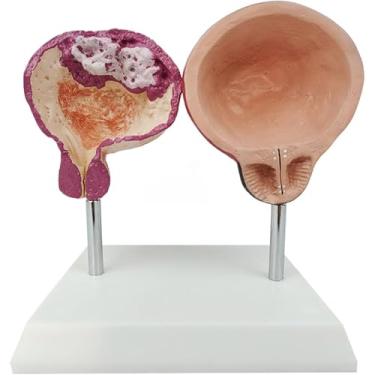 Imagem de Modelo de bexiga saudável vs patológico, modelo de anatomia da bexiga abdominal masculina, demonstração de bexiga de fumo, ferramenta de ensino de urologia, para ensino médico