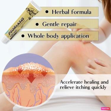Imagem de Tratamento Para Eczema Dermatite Coceira Alergia Acne - Creme