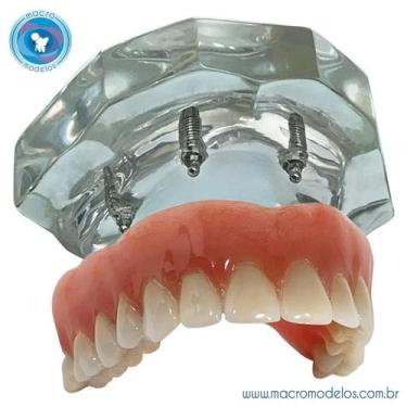 Imagem de Macro Modelo Overdenture em Acrílico com 4 implantes Oring + Prótese S