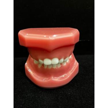 Imagem de RD-038 Modelo Pediatria 5 anos Classe I Mordida Aberta - ROIC