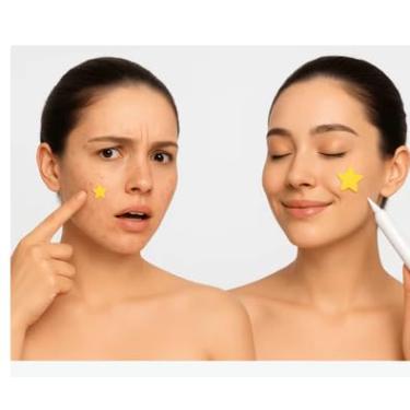 Imagem de Adesivos Anti-Acne em Forma de Estrela, Hidrocoloide com Óleo de Melaleuca e Calêndula, 200 Unidades, Colorido, para Tratamento de Espinhas