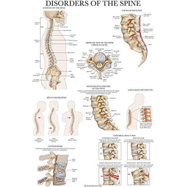 Imagem de Palace Learning Pôster Disorders of the Spine Anatomy - Tabela anatômica laminada de distúrbios da coluna vertebral - 45,7 cm x 61 cm